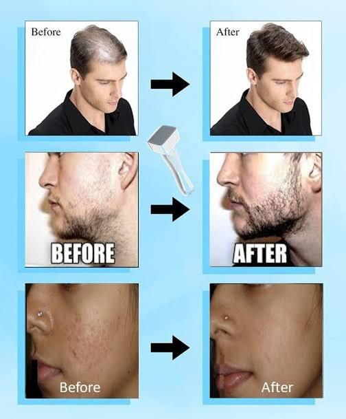 Derma Stamp Roller – 140 Titanium Microneedles for Skin.